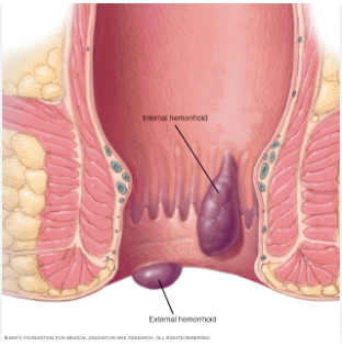 Piles Causes Symptoms and Treatments